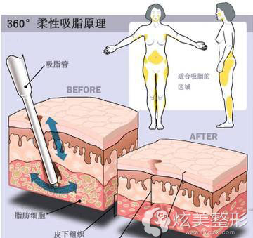 李二天原理瘦身360°吸脂无痕环形术吃饭瘦脸专家采用新宇第打图片