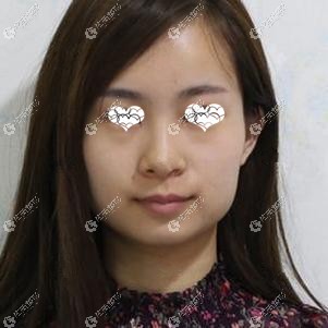 术前嘟嘟肉明显 术前嘟嘟肉明显