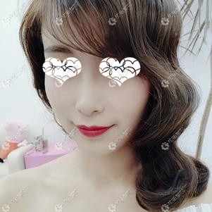 陈志雄医生为我做完意大利悦升线提升15天恢复自然 陈志雄医生为我做完意大利悦升线提升15天恢复自然
