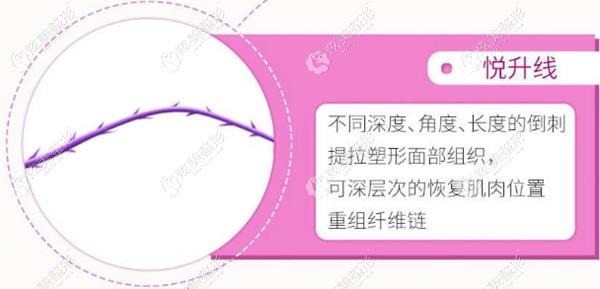 陈志雄医生推荐的意大利悦升线 陈志雄医生推荐的意大利悦升线