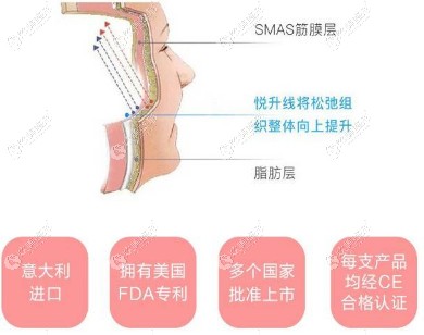 意大利悦升线提升下垂的嘟嘟肉效果较好 意大利悦升线提升下垂的嘟嘟肉效果较好