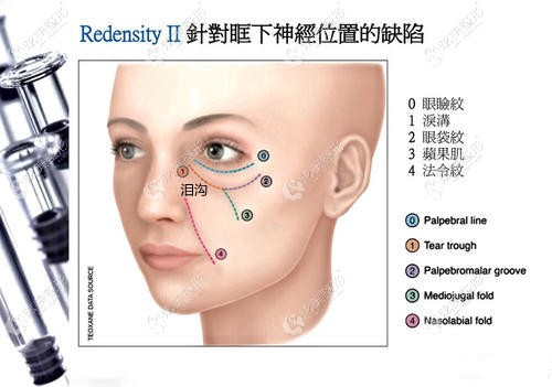 填泪沟前要看下7d洛伊熊猫针的注射位置图,才知道为啥不会有后遗症