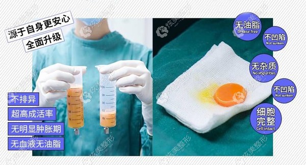 采用ACT脂肪填充的方式造出来的脂肪