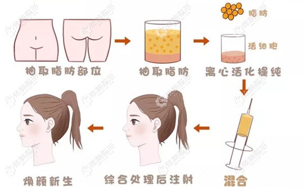 自体脂肪面部填充原理
